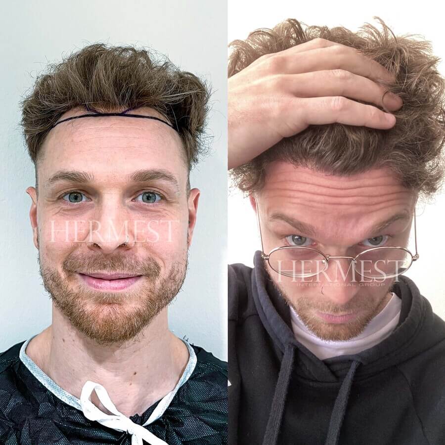 HERMEST Landing Deutsch de2 Hermest Hair Clinic